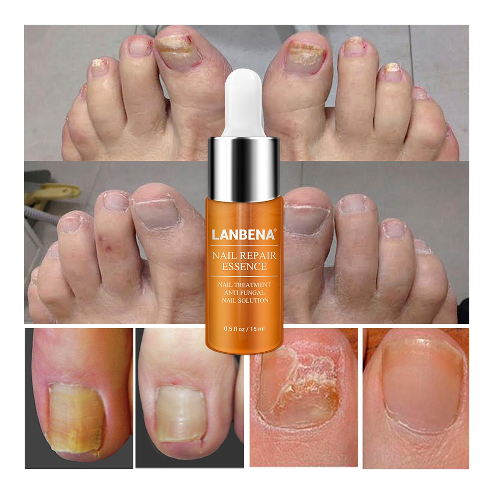 Nail Fungus Treatment Labrena Serum 12ml Nail Fungus Treatment Labrena Serum 12ml