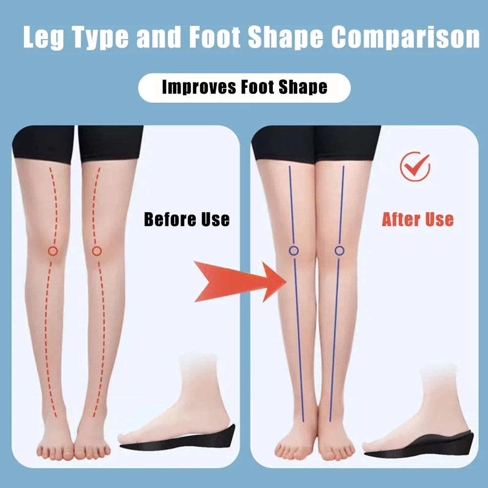 Orthotic Insoles for Plantar Fasciitis Pain Relief Therapy Flat Feet Arch Support Insoles for Shoes Women Men XO-Legs