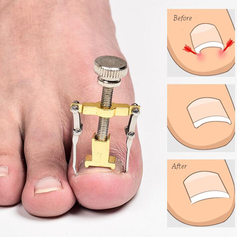 Pedicure Tool Ingrown Toe Nail Corrector Paronychia Chiropody Podiatry Foot Care Repair Nail Clipper