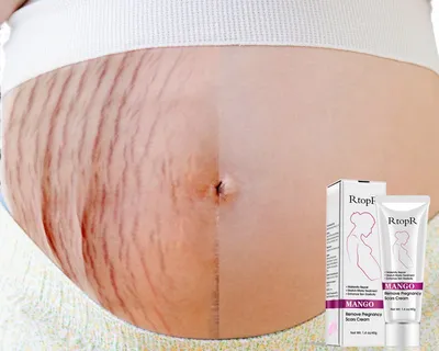 Pregnancy Stretch Mark Cream Pregnancy Stretch Mark Cream