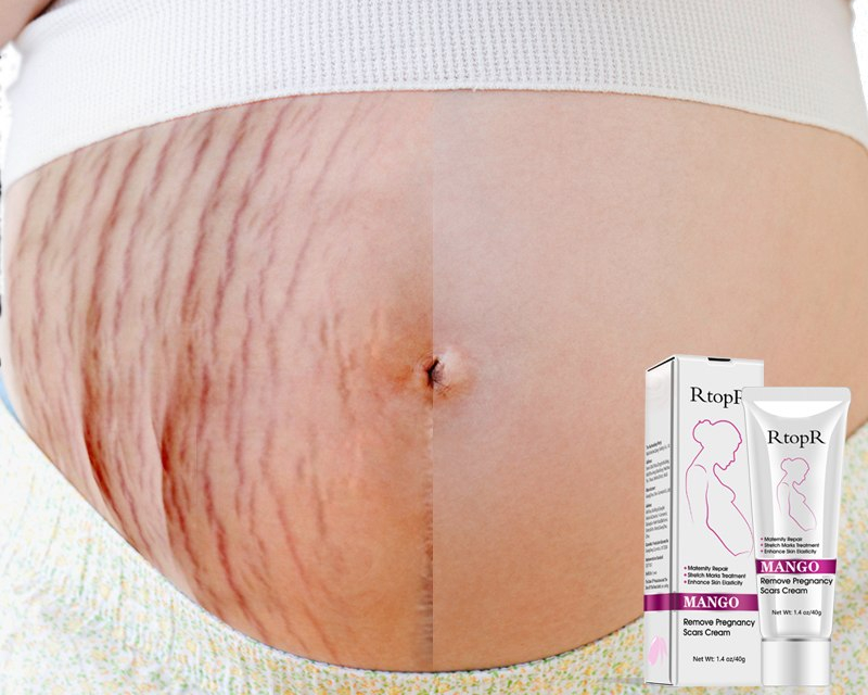 Pregnancy Stretch Mark Cream Pregnancy Stretch Mark Cream