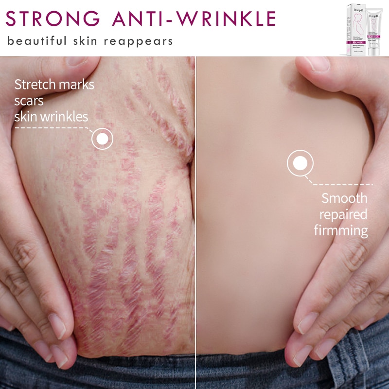 Pregnancy Stretch Mark Cream Pregnancy Stretch Mark Cream