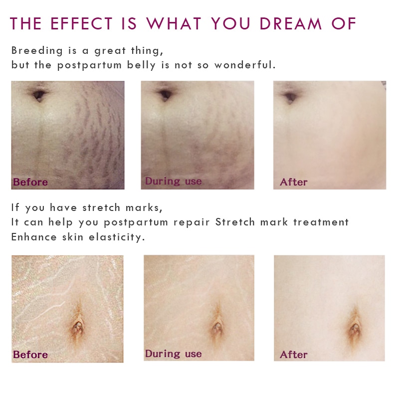 Pregnancy Stretch Mark Cream Pregnancy Stretch Mark Cream