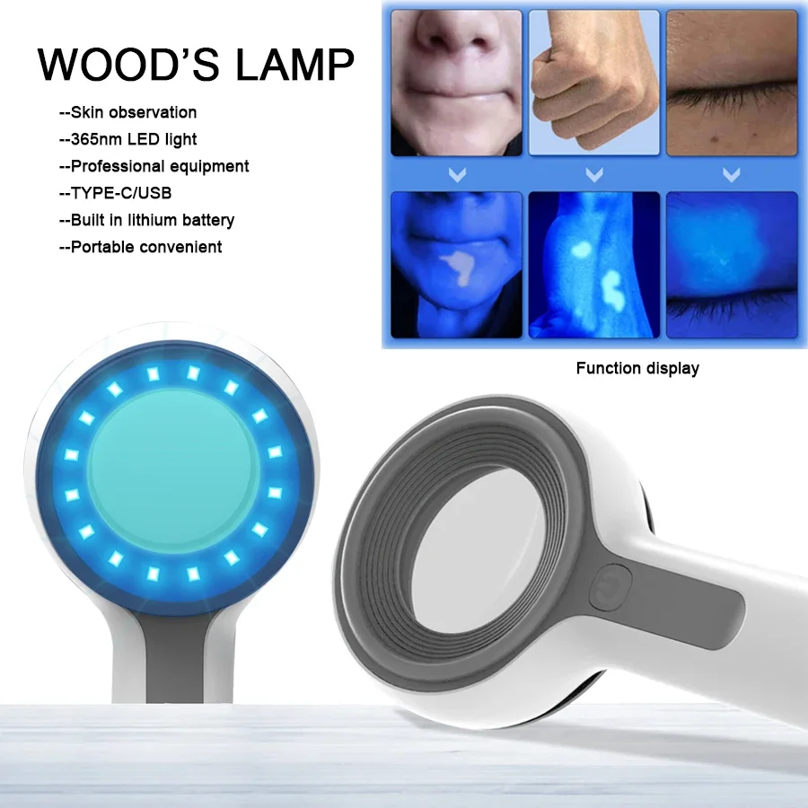 Rechargeable Wood's Lamp Ultraviolet Skin Analysis For Skin Examination Test Medical Diagnostic Analyzer Machine