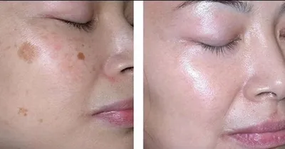 Remove Dark Spots Effective Whitening Freckles Cream Fade Melanin Anti Pigmentation Improve Dullness Fast Brighten Skin Remove Dark Spots Effective Whitening Freckles Cream Fade Melanin Anti Pigmentation Improve Dullness Fast Brighten Skin