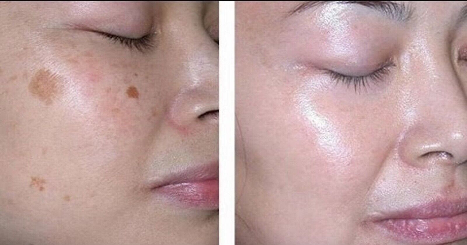 Remove Dark Spots Effective Whitening Freckles Cream Fade Melanin Anti Pigmentation Improve Dullness Fast Brighten Skin Remove Dark Spots Effective Whitening Freckles Cream Fade Melanin Anti Pigmentation Improve Dullness Fast Brighten Skin