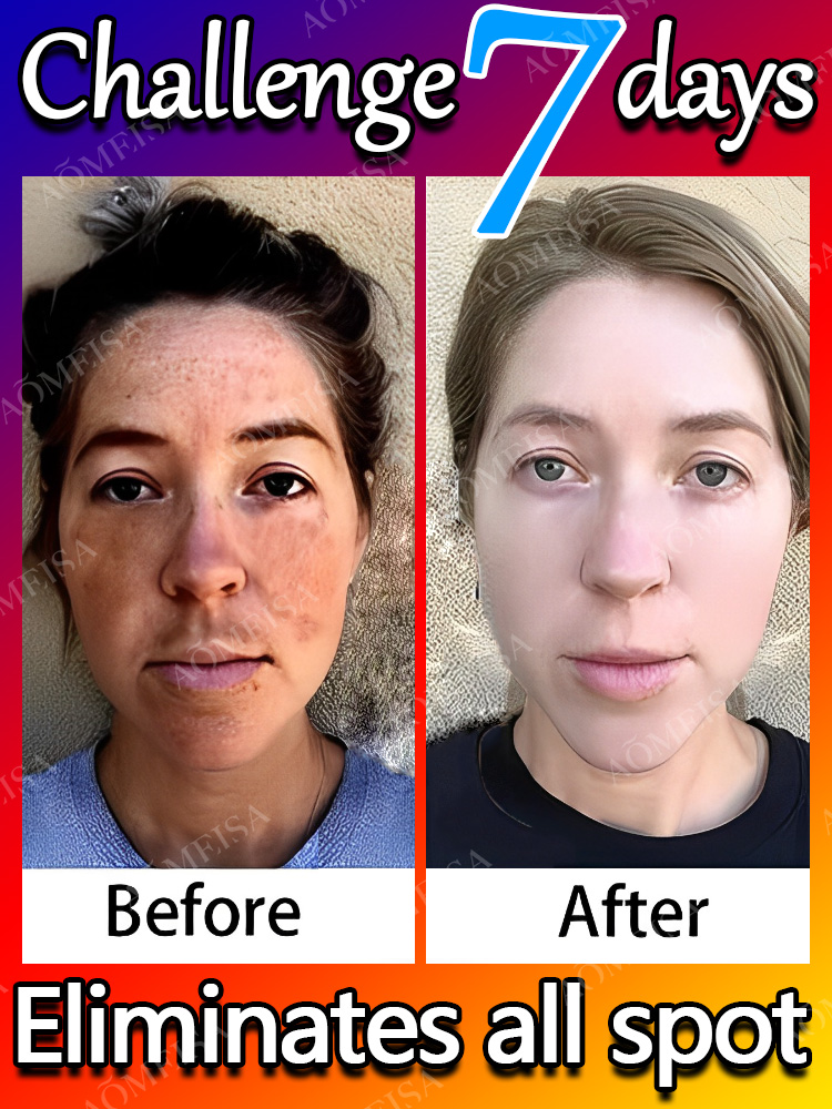 Remove Dark Spots Effective Whitening Freckles Cream Fade Melanin Anti Pigmentation Improve Dullness Fast Brighten Skin Remove Dark Spots Effective Whitening Freckles Cream Fade Melanin Anti Pigmentation Improve Dullness Fast Brighten Skin
