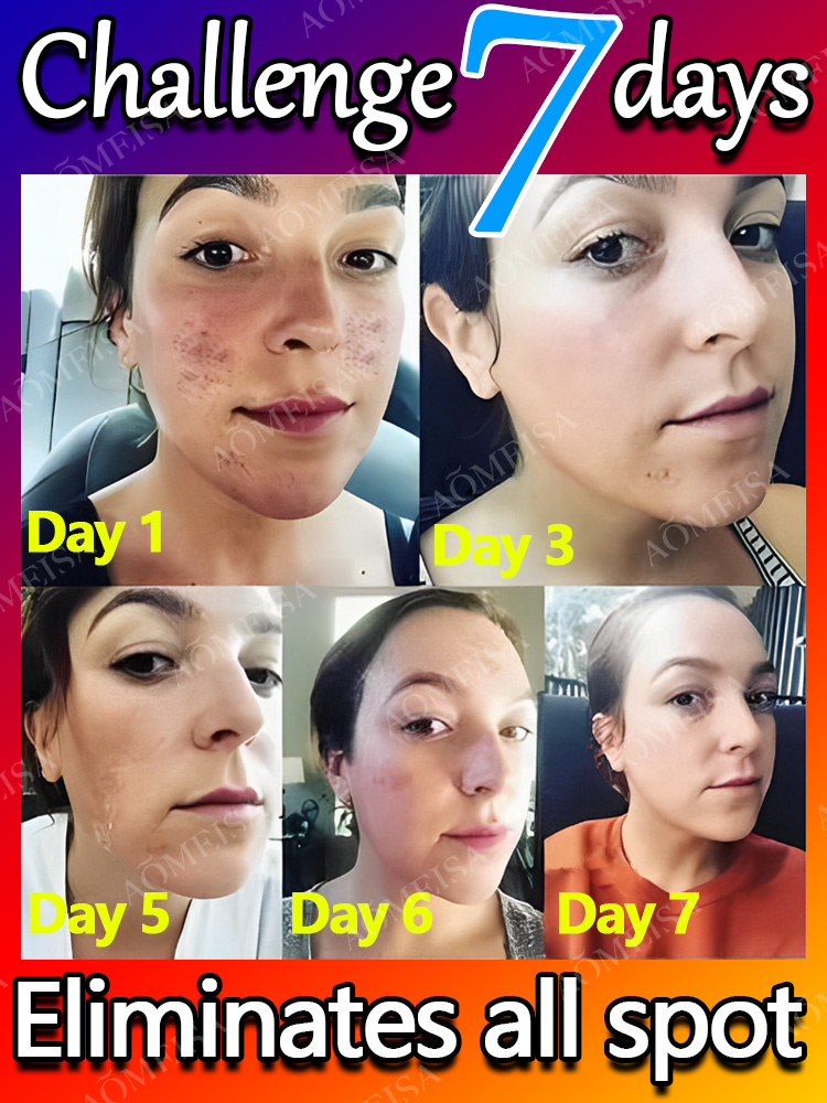 Remove Dark Spots Effective Whitening Freckles Cream Fade Melanin Anti Pigmentation Improve Dullness Fast Brighten Skin Remove Dark Spots Effective Whitening Freckles Cream Fade Melanin Anti Pigmentation Improve Dullness Fast Brighten Skin