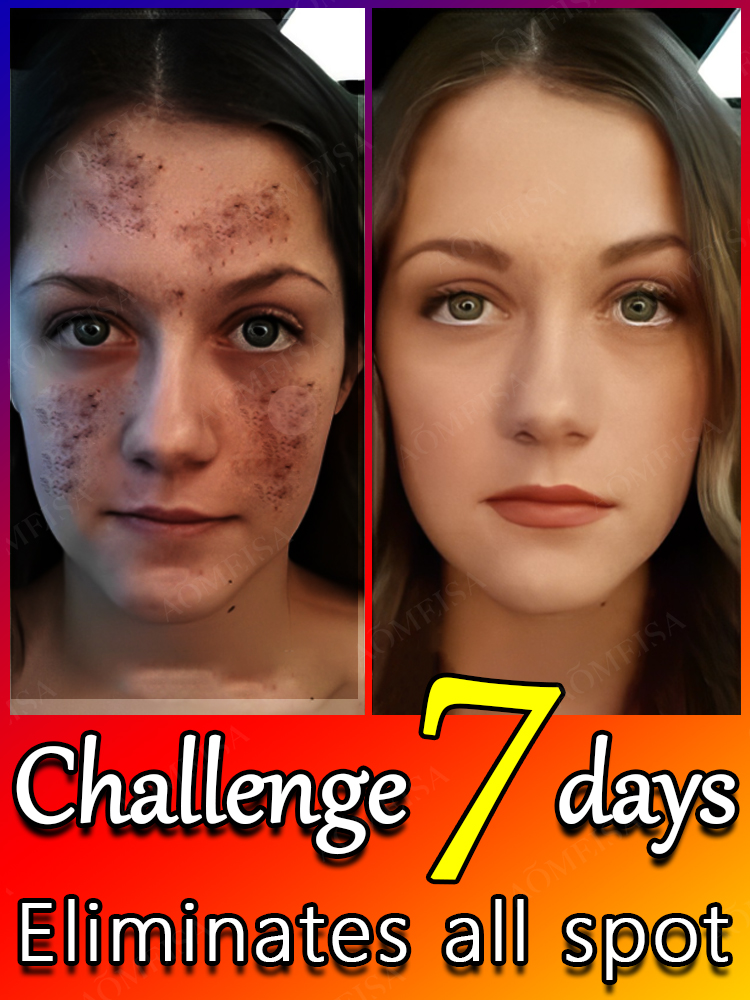 Remove Dark Spots Effective Whitening Freckles Cream Fade Melanin Anti Pigmentation Improve Dullness Fast Brighten Skin Remove Dark Spots Effective Whitening Freckles Cream Fade Melanin Anti Pigmentation Improve Dullness Fast Brighten Skin