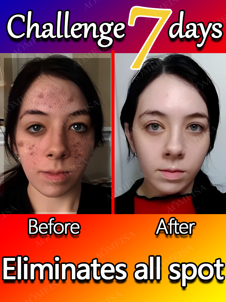 Remove Dark Spots Effective Whitening Freckles Cream Fade Melanin Anti Pigmentation Improve Dullness Fast Brighten Skin Remove Dark Spots Effective Whitening Freckles Cream Fade Melanin Anti Pigmentation Improve Dullness Fast Brighten Skin