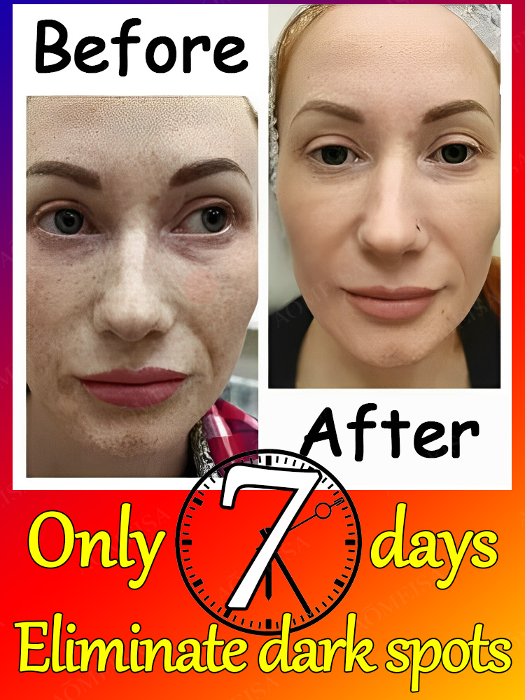 Remove Dark Spots Effective Whitening Freckles Cream Fade Melanin Anti Pigmentation Improve Dullness Fast Brighten Skin Remove Dark Spots Effective Whitening Freckles Cream Fade Melanin Anti Pigmentation Improve Dullness Fast Brighten Skin