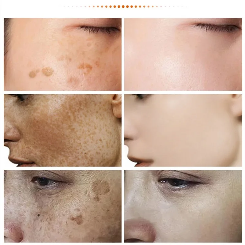 Remove Melasma Freckles Cream Face Dark Spots Remover for Women Removal Melanin Whitening Cream Fade Spots Skin Remove Melasma Freckles Cream Face Dark Spots Remover for Women Removal Melanin Whitening Cream Fade Spots Skin