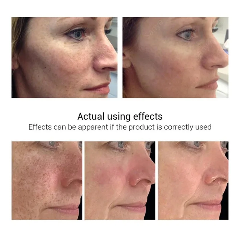 Remove Melasma Freckles Cream Face Dark Spots Remover for Women Removal Melanin Whitening Cream Fade Spots Skin Remove Melasma Freckles Cream Face Dark Spots Remover for Women Removal Melanin Whitening Cream Fade Spots Skin