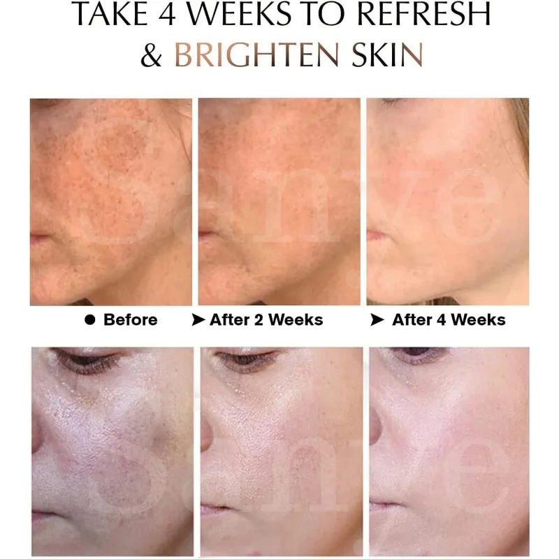 Remove Melasma Freckles Cream Face Dark Spots Remover for Women Removal Melanin Whitening Cream Fade Spots Skin Remove Melasma Freckles Cream Face Dark Spots Remover for Women Removal Melanin Whitening Cream Fade Spots Skin