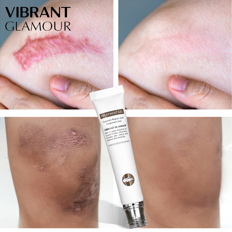 Scar Cream Acne Treatment Gel Ointment Scar Cream Acne Treatment Gel Ointment