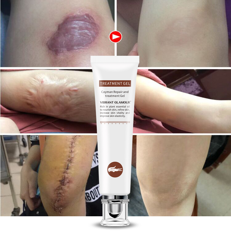 Scar Cream Acne Treatment Gel Ointment Scar Cream Acne Treatment Gel Ointment