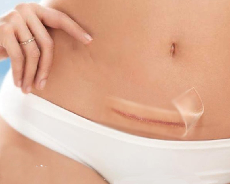 Silicone Scar Sheets Reusable Patches