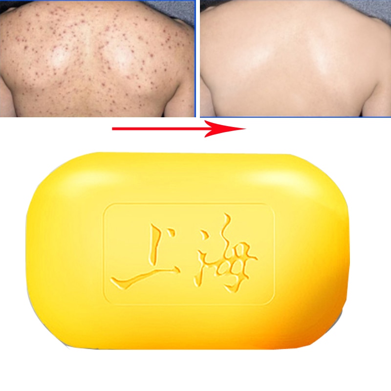 Sulfur Soap For Acne Skin Cleanser