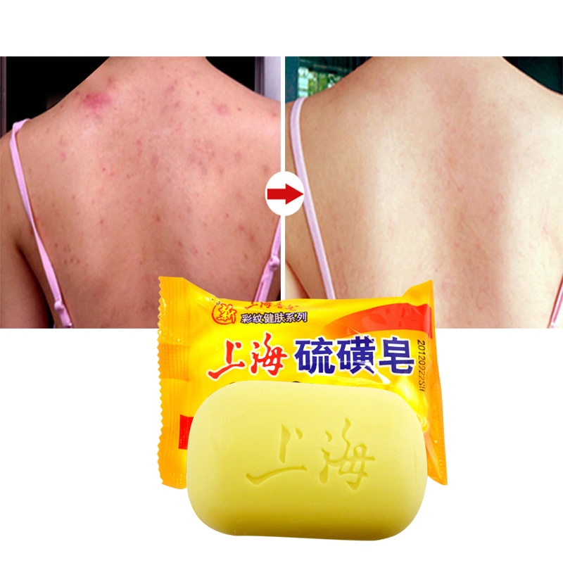 Sulfur Soap For Acne Skin Cleanser Sulfur Soap For Acne Skin Cleanser