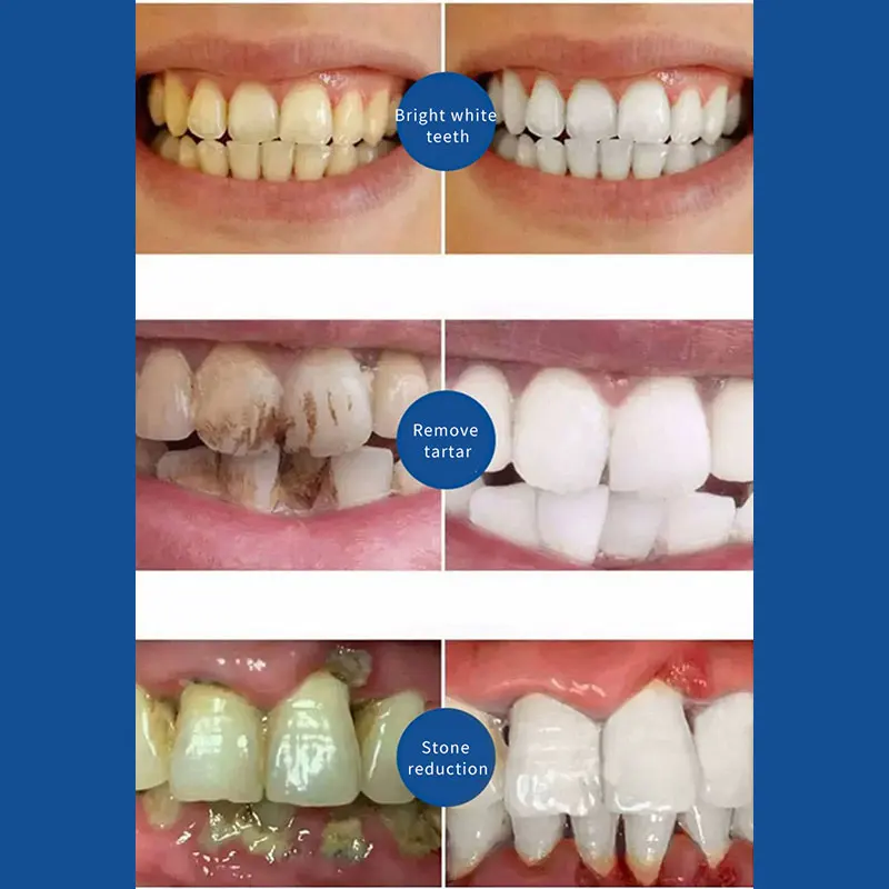 Toothpaste For Plaque Removal Quick Repair Of Cavities Deep Cleaning Removal Of Tartar Whitening Of Teeth Fresh Breath