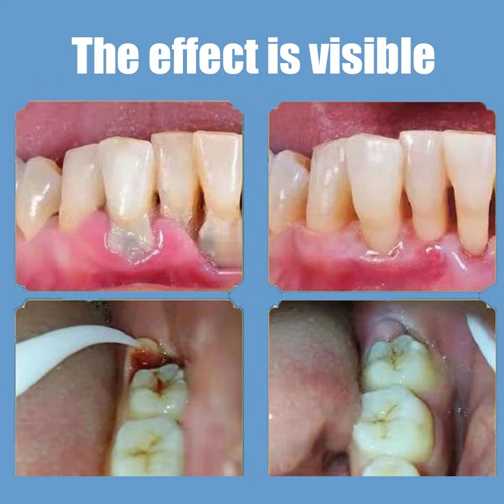 Toothpaste For Plaque Removal Quick Repair Of Cavities Deep Cleaning Removal Of Tartar Whitening Of Teeth Fresh Breath