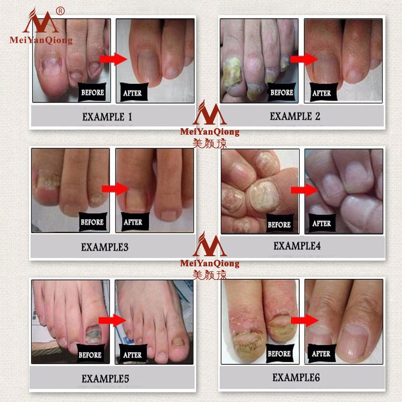 Topical Antifungal Nail Care Oil Topical Antifungal Nail Care Oil