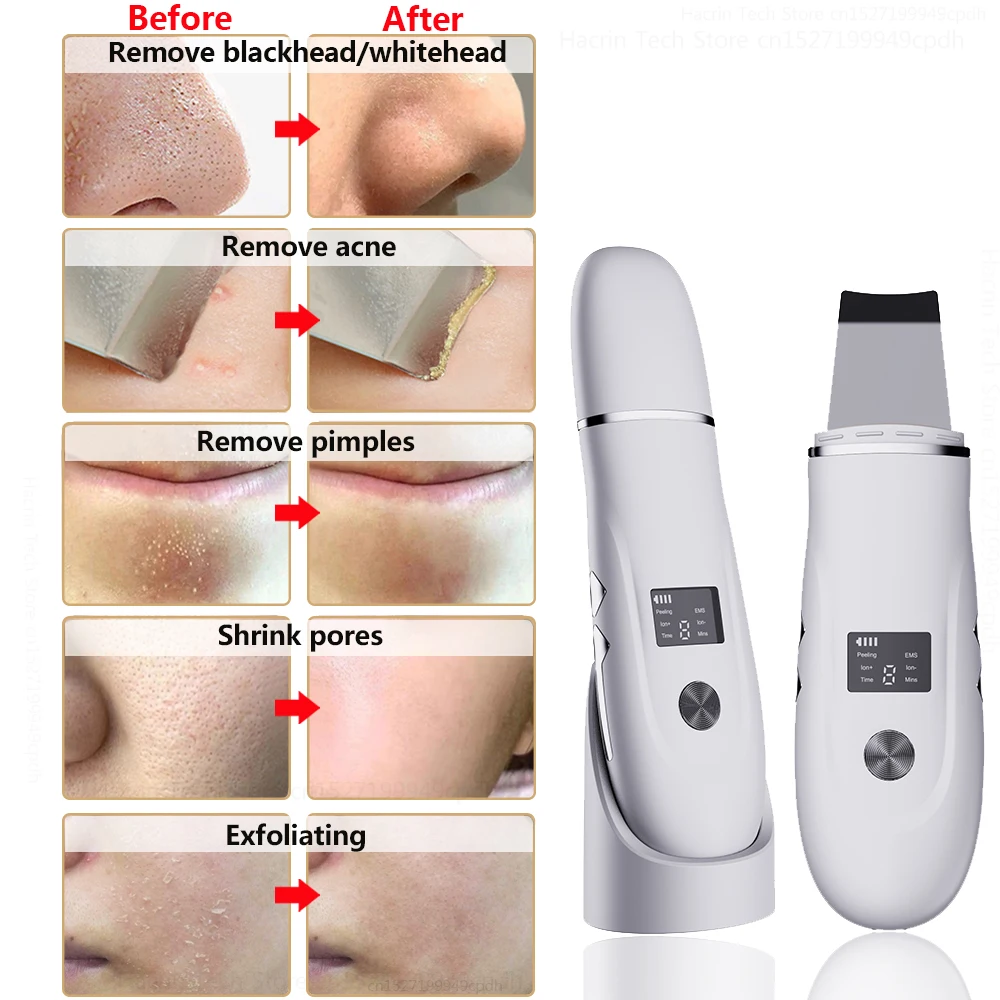 Ultrasonic Peeling Remover Blackhead Facial Skin Scrubber Facial Shovel Deep Cleaning Face Lifting Removal Pore Acne