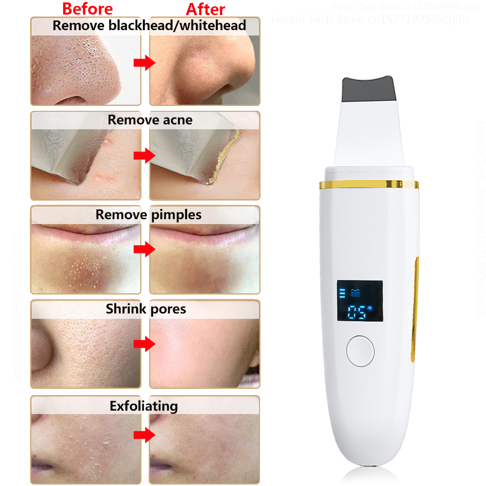 Ultrasonic Skin Scrubber Remover Blackhead Ultrasonic Peeling Facial Scrubber Shovel Deep Cleaning Face Lifting Remove Ultrasonic Skin Scrubber Remover Blackhead Ultrasonic Peeling Facial Scrubber Shovel Deep Cleaning Face Lifting Remove