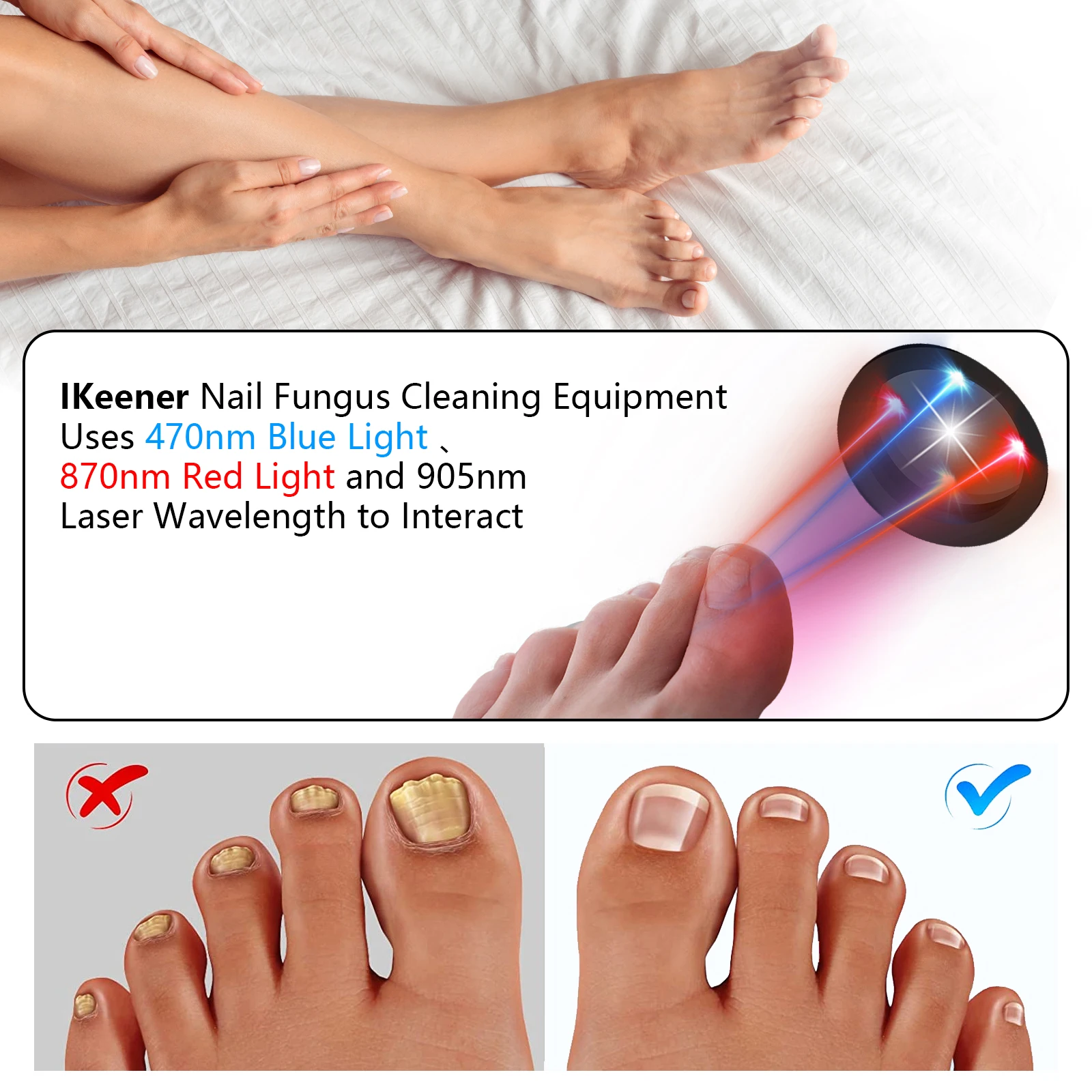 USB Rechargeable Nail Fungus Laser Device Toenail Laser Therapy Machine Anti Fungal Laser Equipment for Onychomycosis