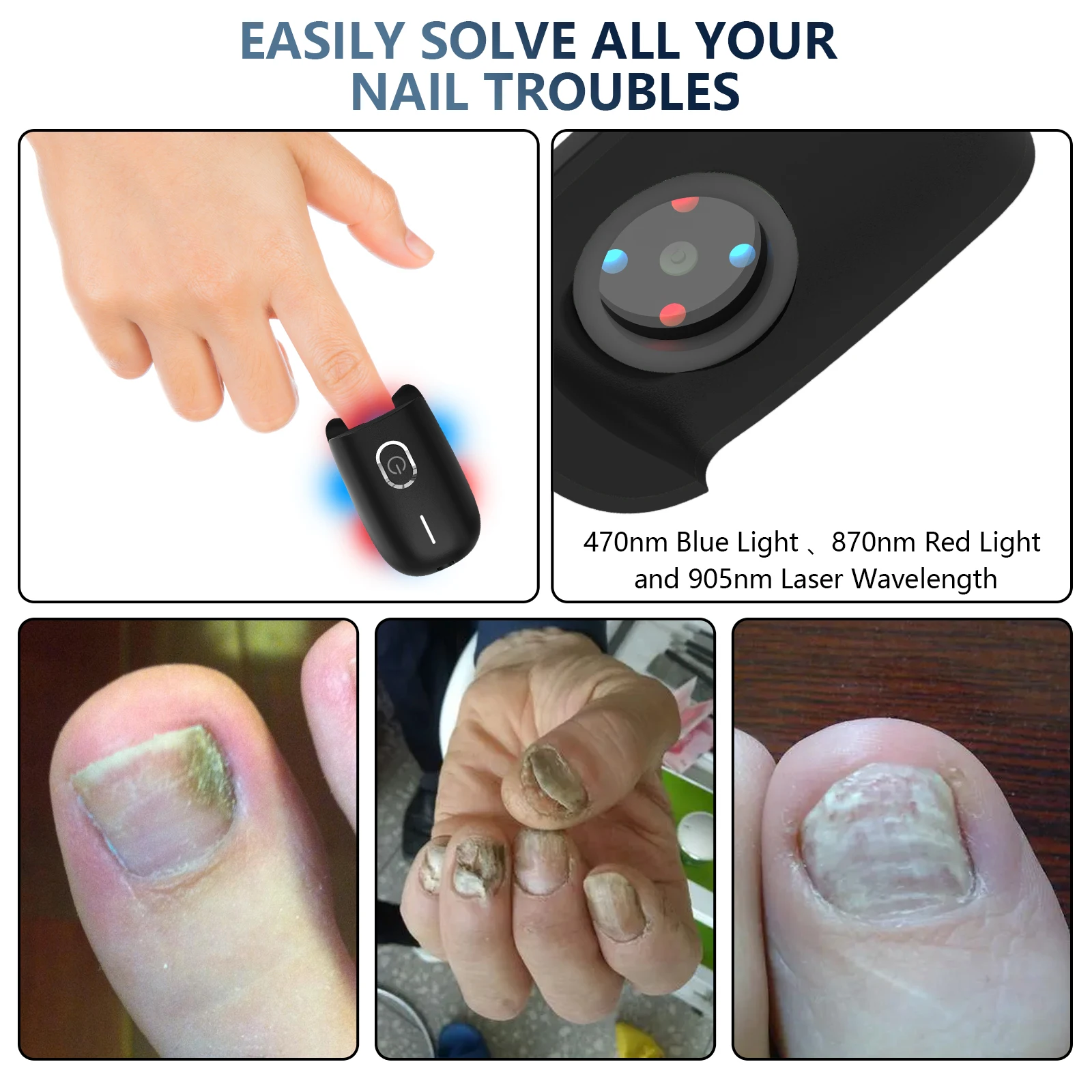 USB Rechargeable Nail Fungus Laser Device Toenail Laser Therapy Machine Anti Fungal Laser Equipment for Onychomycosis