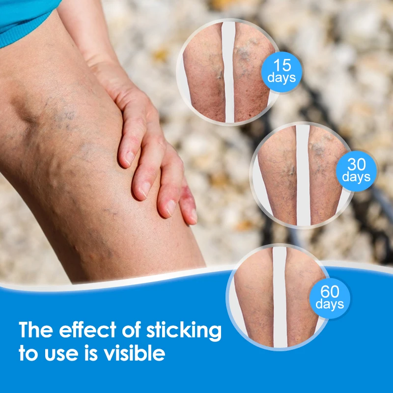 Varicose Veins Patches