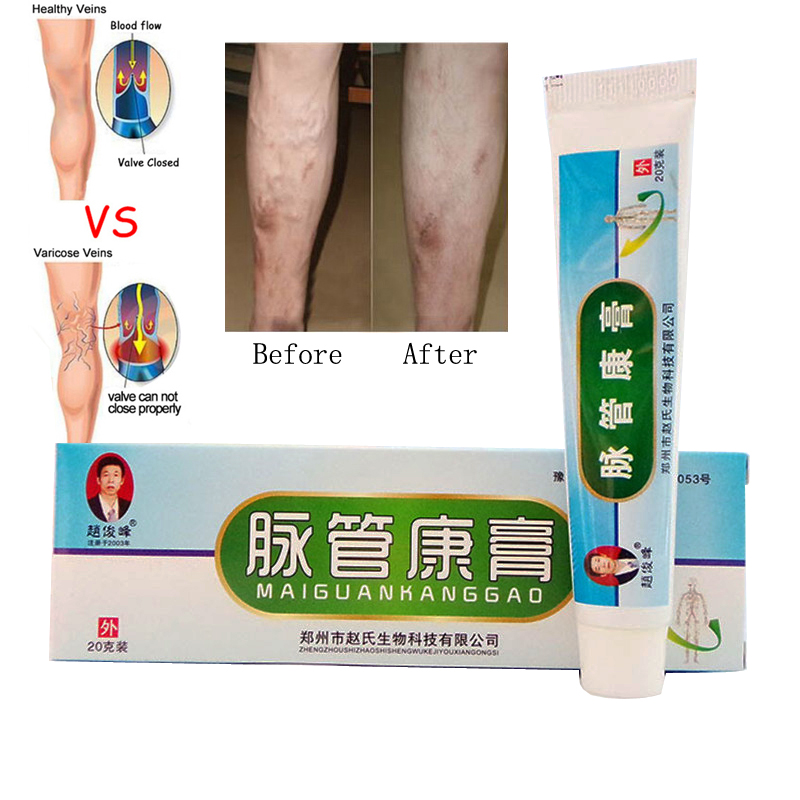 Varicose Veins Treatment Ointment Varicose Veins Treatment Ointment