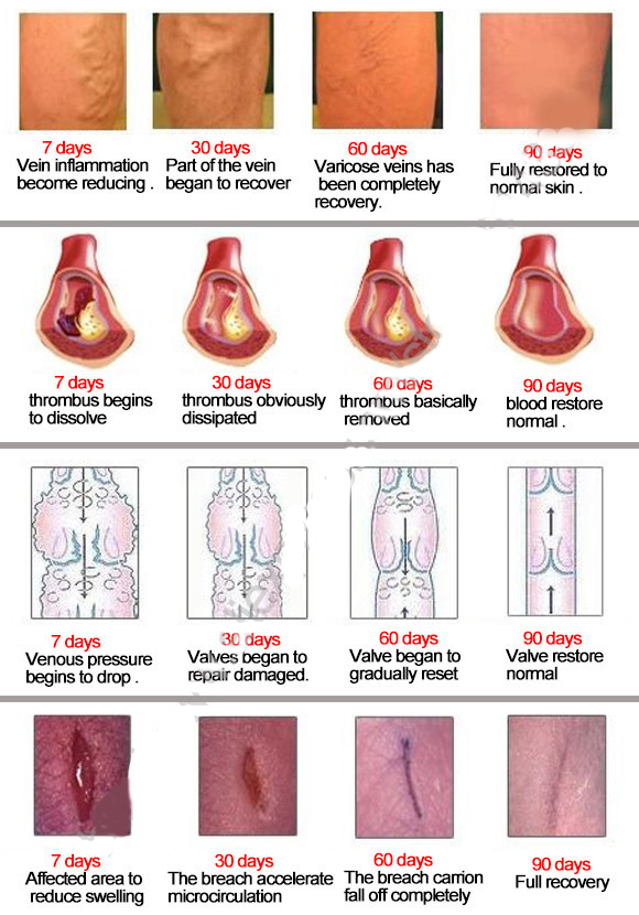 Varicose Veins Treatment Ointment Varicose Veins Treatment Ointment