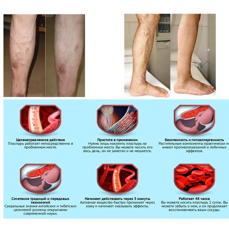 Varicose Veins Treatment Plaster (Set of 24) Varicose Veins Treatment Plaster (Set of 24)