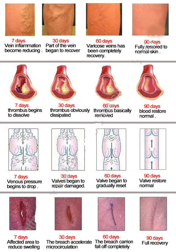 Varicose Veins Treatment Plaster (Set of 24) Varicose Veins Treatment Plaster (Set of 24)
