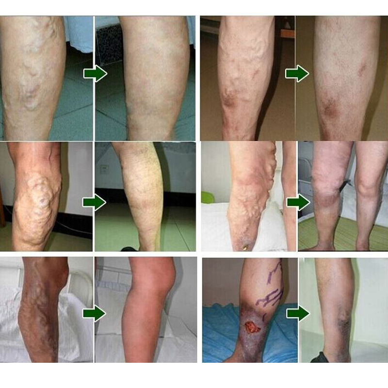 Varicose Veins Treatment Plaster (Set of 24) Varicose Veins Treatment Plaster (Set of 24)